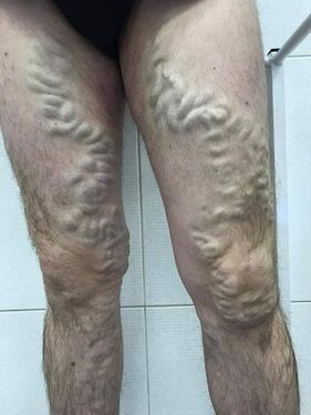 damarên varikoz ên mêr îhmal kirin