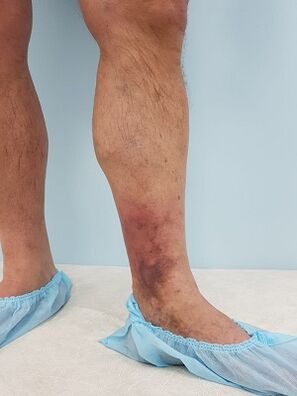 komplîkasyonên ji damarên varicose di mêran de