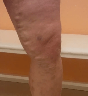 Veins Varicose