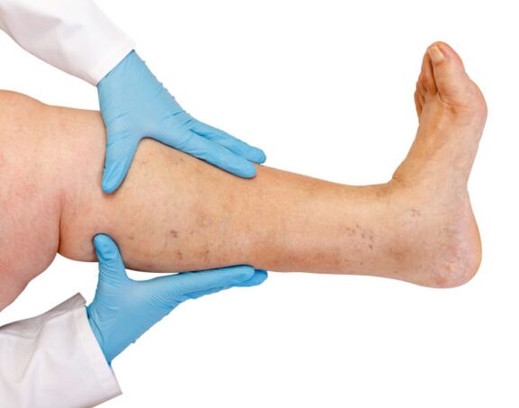 Veins Varicose li ser lingan