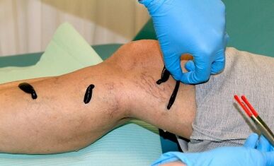Hirudotherapy ji bo varicose veins