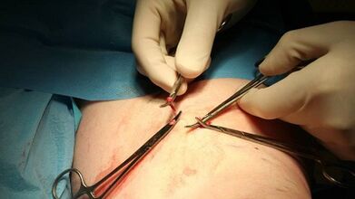 Flebectomy ji bo varicose veins