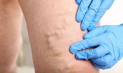 Veins Varicose li ser lingan