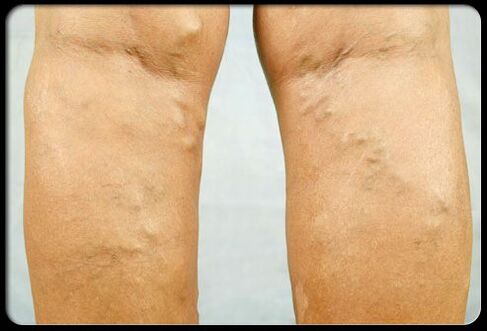Veins Varicose li ser lingan